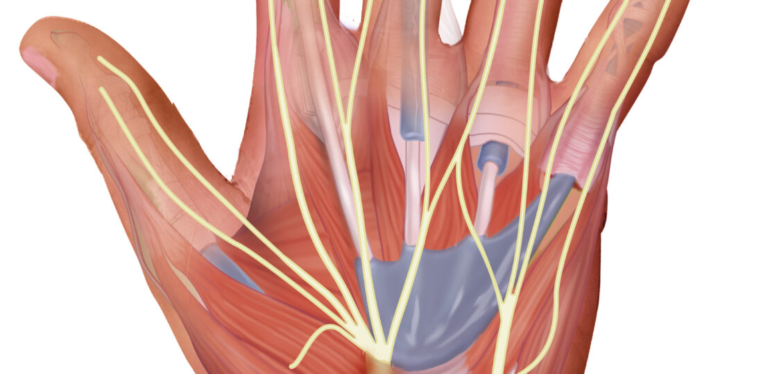 hand3-carpal tunnel sydroom-exp