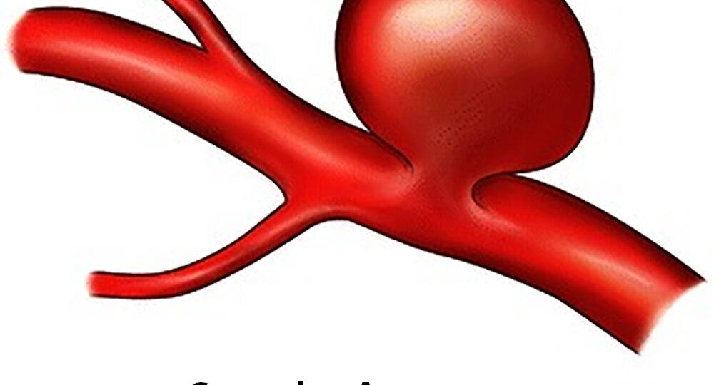 saccular_aneusysm_w